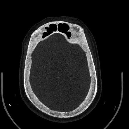 Underdiagnosed And Undertreated Acromegaly Case Challenge