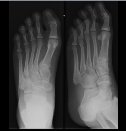 Metatarsus adductus | Radiology Case | Radiopaedia.org