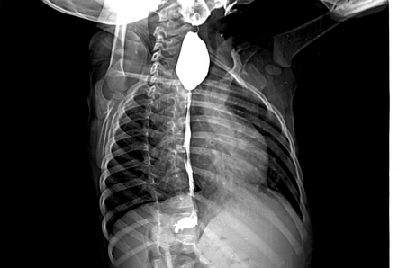 Esophageal Webs And Rings Background Pathophysiology