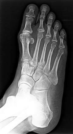 Lisfranc injury | Radiology Reference Article | Radiopaedia.org