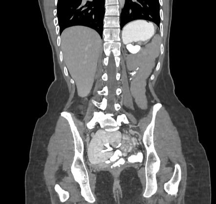 Mayer-Rokitansky-Küster-Hauser syndrome (atypical) | Radiology Case ...