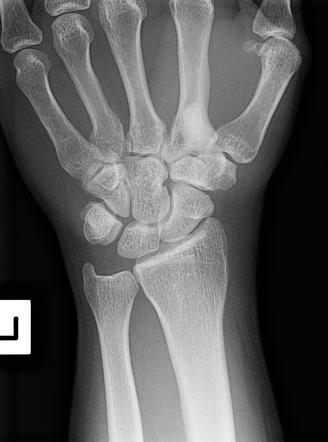 Melorheostosis | Radiology Case | Radiopaedia.org