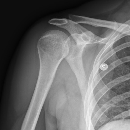 Posterior shoulder dislocation with reverse Hill-Sachs and reverse ...