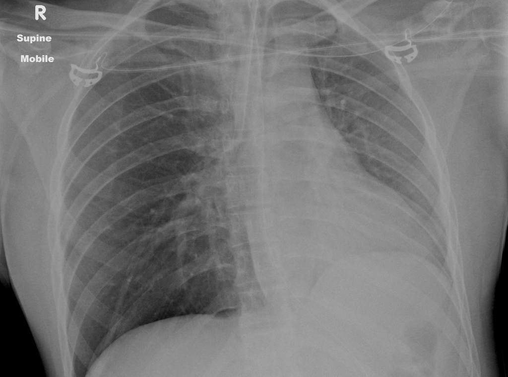 endotracheal tube size right