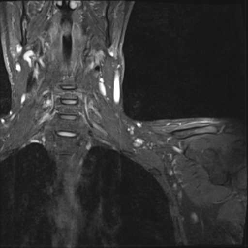 Brachial plexus (normal) | Image | Radiopaedia.org