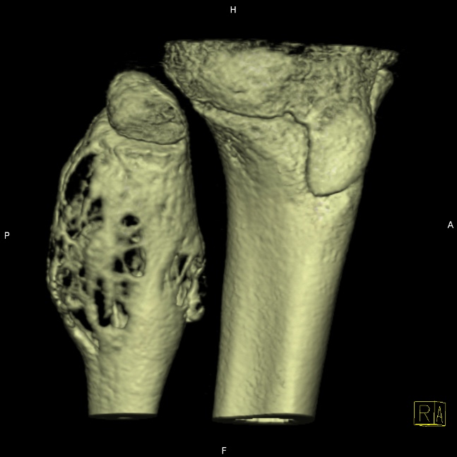 Aneurysmal bone cyst (ABC) | Image | Radiopaedia.org