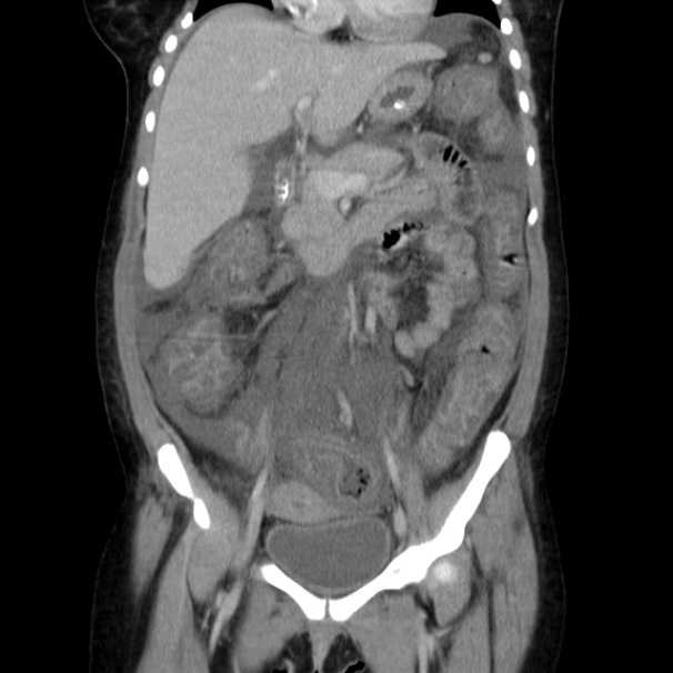 Pseudomembranous colitis | Image | Radiopaedia.org