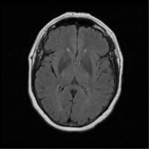 Meningioma - microcystic | Image | Radiopaedia.org