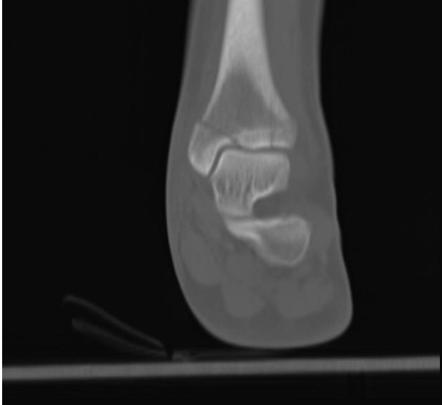 Pilon Fracture Radiology Reference Article Radiopaedia Org