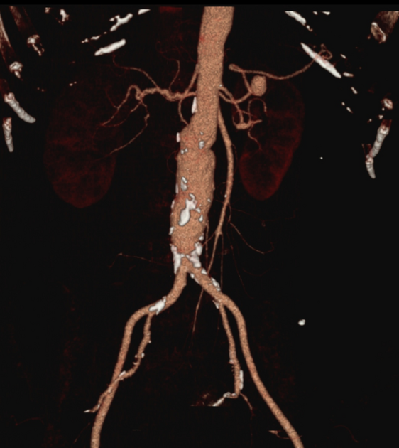 visceral artery aneurysm