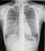 Viewing playlist: MD tute 1- mediastinal masses | Radiopaedia.org