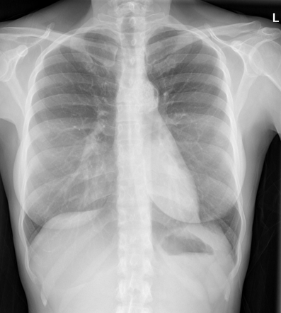 Calcified anterior mediastinal mass: treated lymphoma | Radiology Case ...