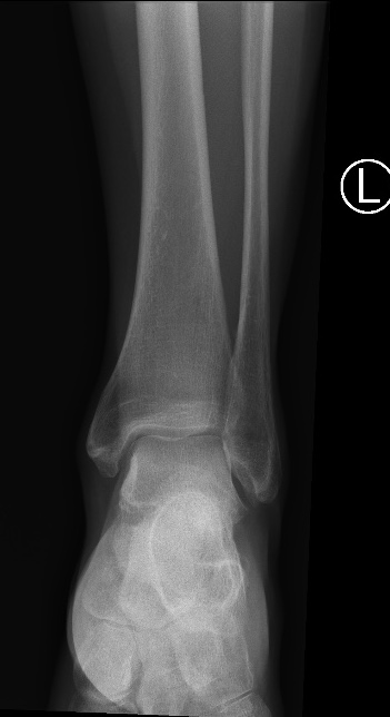 Dorsal talar avulsion fracture | Image | Radiopaedia.org