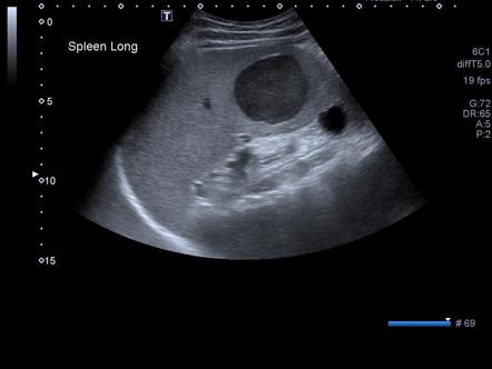 Splenic cyst | Radiology Reference Article | Radiopaedia.org