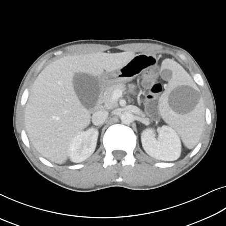 Splenic cyst | Radiology Reference Article | Radiopaedia.org