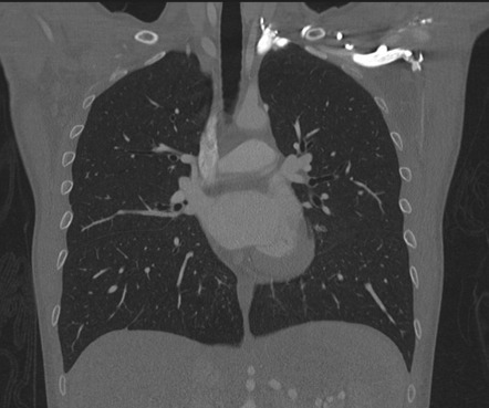 Inferior accessory fissure of the lung | Radiology Reference Article ...