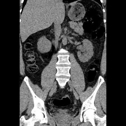 Left ureteric calculus | Image | Radiopaedia.org