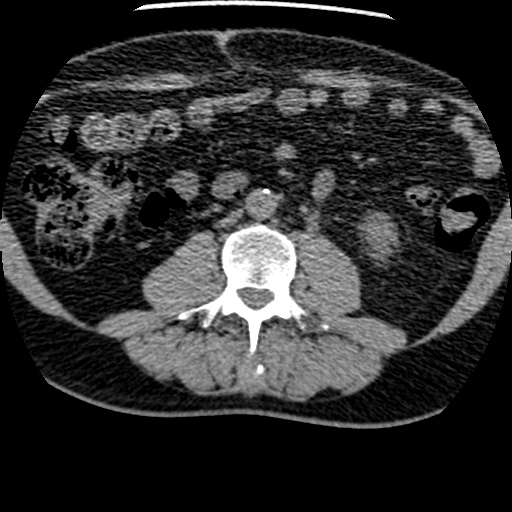 Left ureteric calculus | Image | Radiopaedia.org