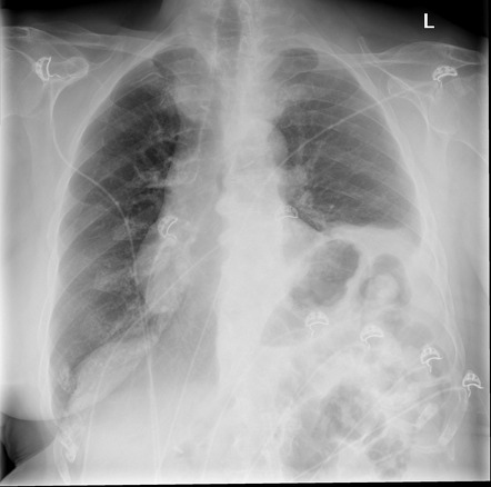 Phrenic nerve palsy | Radiology Reference Article | Radiopaedia.org