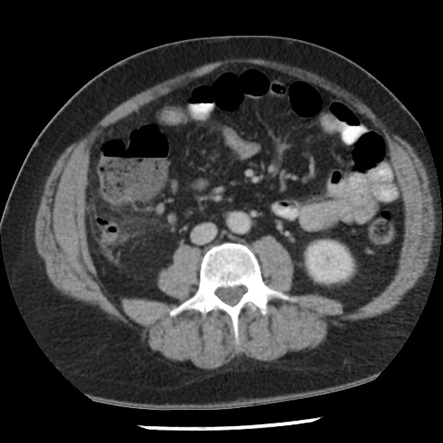 Featured image of post Radiopaedia Appendicitis Case contributed by dr rahul chivate