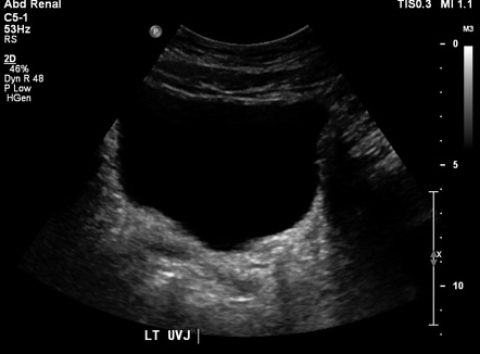 Left ureteric calculus | Image | Radiopaedia.org