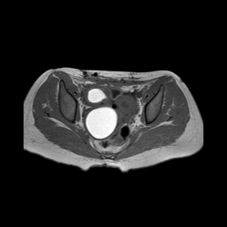 Hematometrocolpos Radiology Reference Article Radiopaedia Org