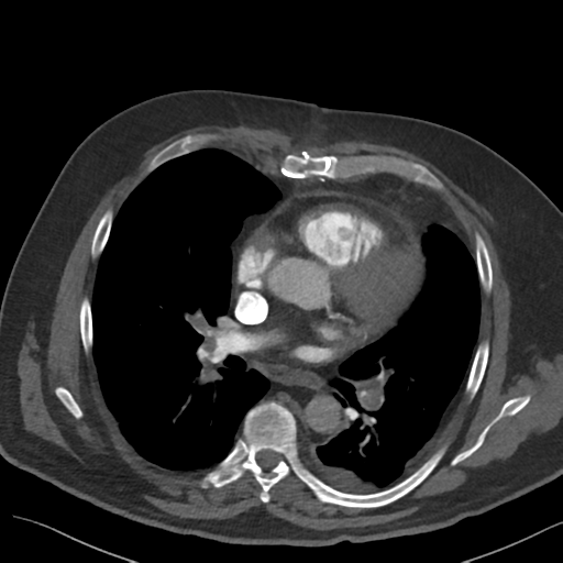 Saddle pulmonary emboli with right ventricular strain and pulmonary ...