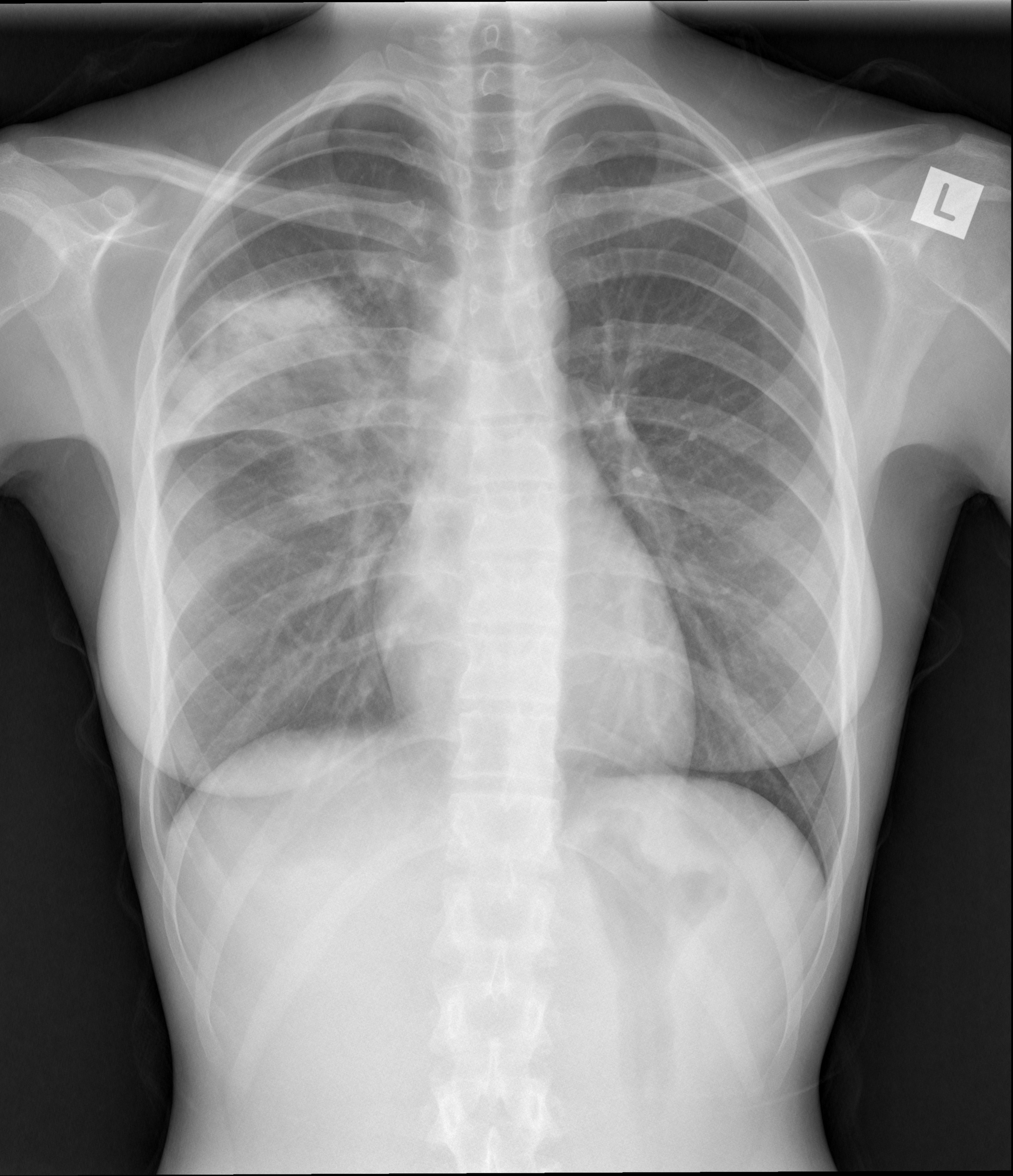 Pa Chest X Ray