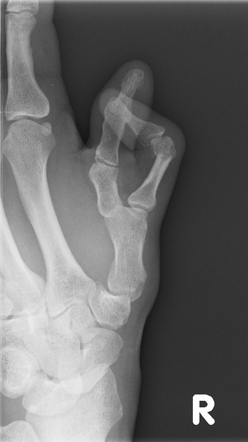 Fracture Of Phalanx In Polydactyly Radiology Case Radiopaedia Org