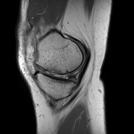 Chondromalacia with premature osteoarthritis | Radiology Case ...