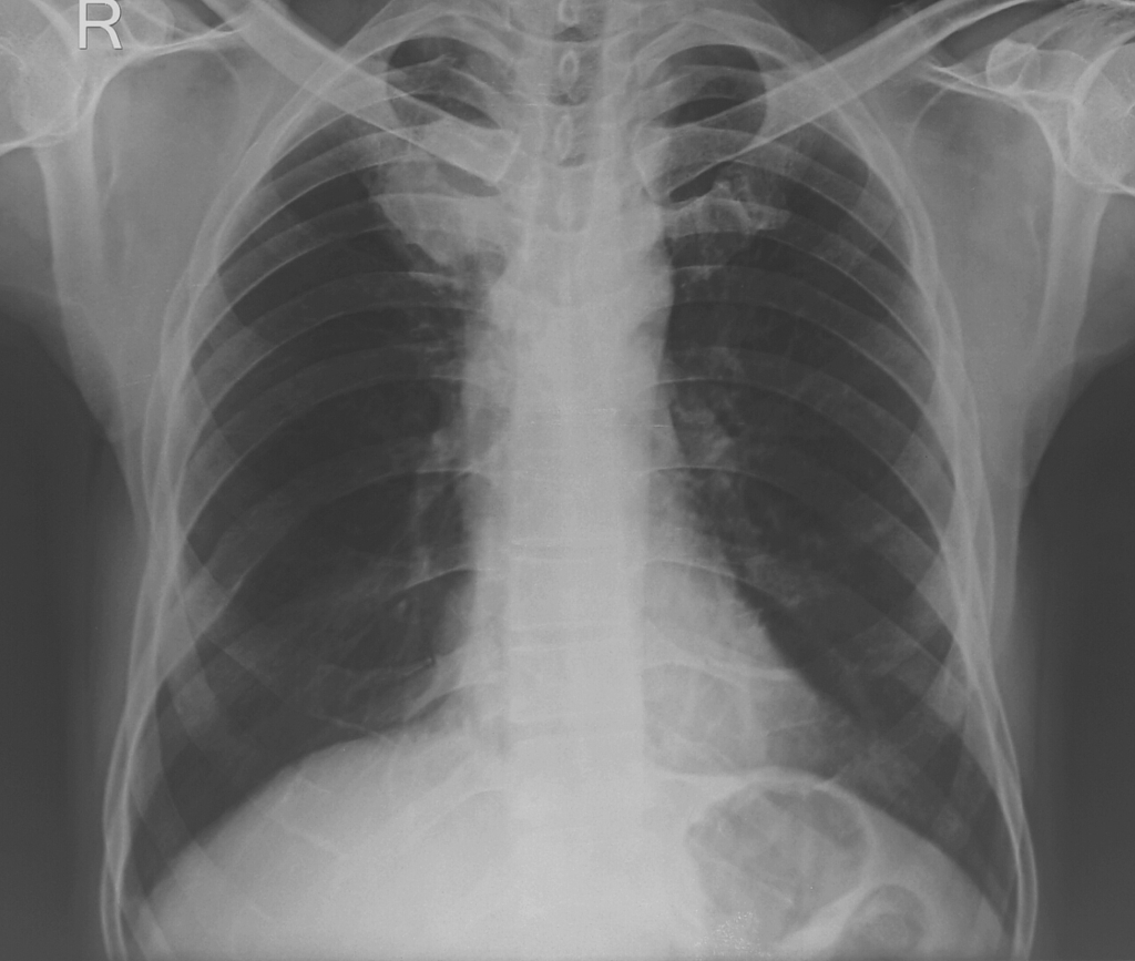 inferior vena cava syndrome