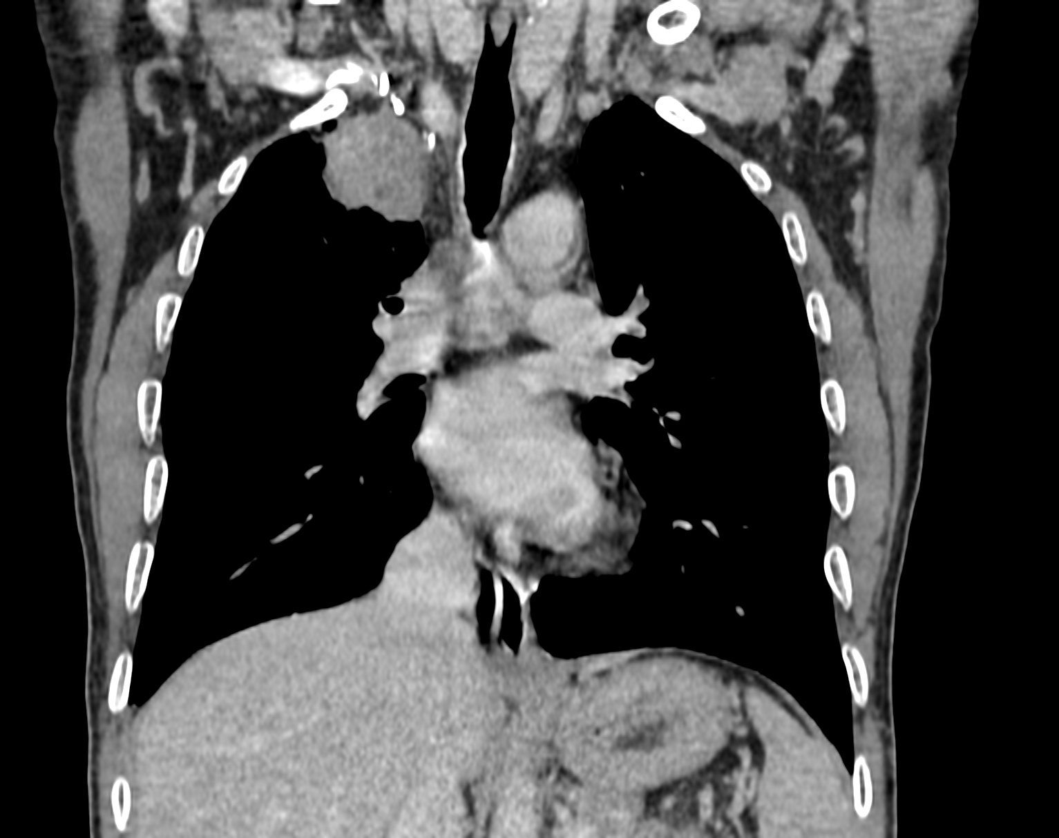 Bronchogenic carcinoma with superior vena cava syndrome | Image ...