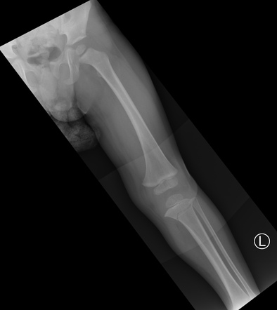 Tibial metadiaphyseal fracture - trampoline fracture | Radiology Case ...