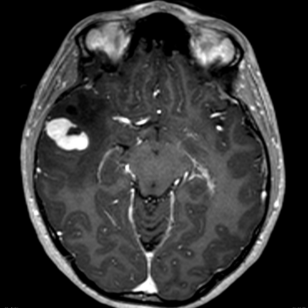 Ganglioglioma | Radiology Reference Article | Radiopaedia.org