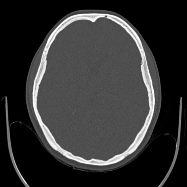 Calvarial osteoma | Image | Radiopaedia.org