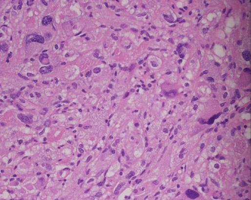 Pleomorphic xanthoastrocytoma | Image | Radiopaedia.org