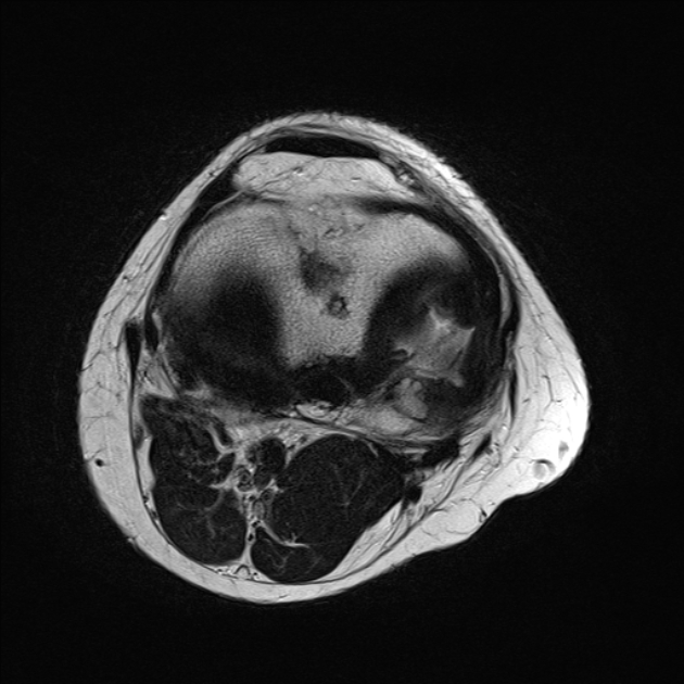 Chondromalacia with premature osteoarthritis | Image | Radiopaedia.org