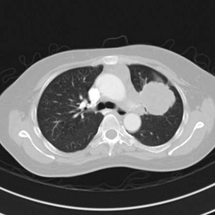 Playlist 'Pulmonary Neoplasms and Tumour Mimics' by Dr K Hussain