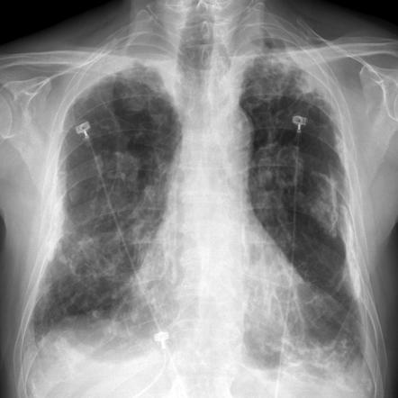 Asbestos related lung and pleural disease | Radiology Case ...