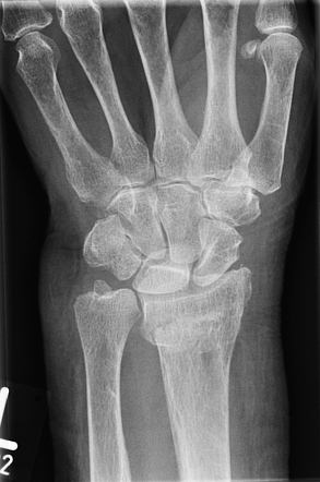 Forearm fracture | Radiology Reference Article | Radiopaedia.org