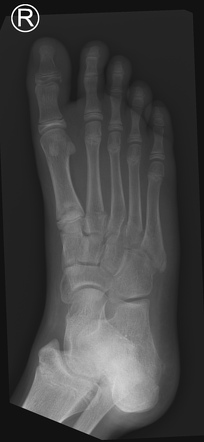 Multiple base of metatarsal fractures | Image | Radiopaedia.org