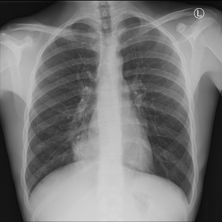 Medial segment of right middle lobe consolidation | Radiology Case ...