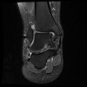 Osteochondral injury staging | Radiology Reference Article ...