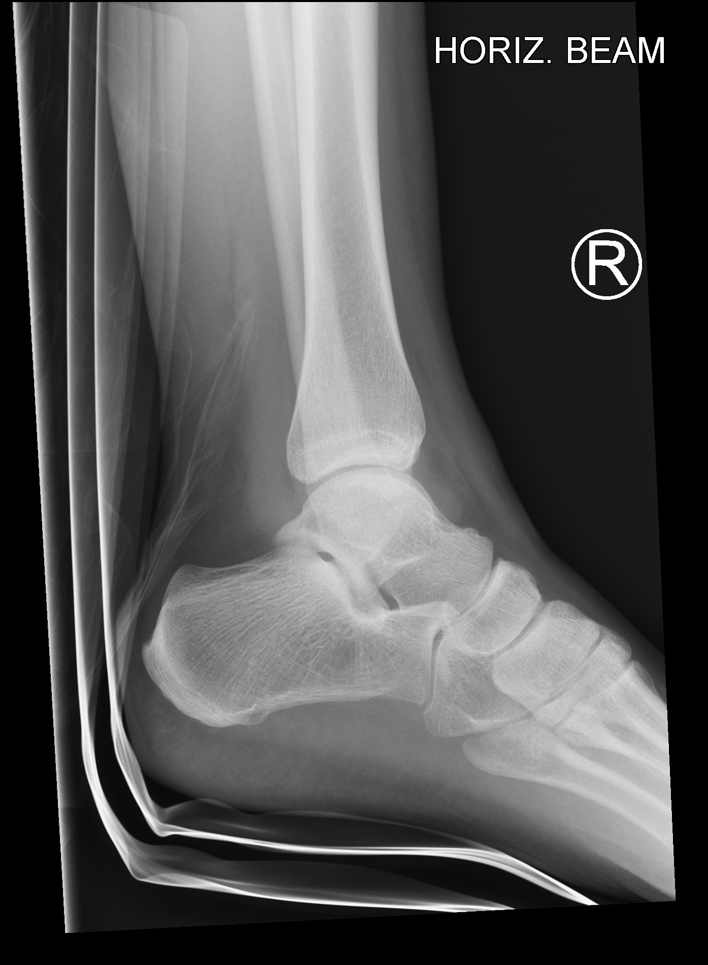 Ankle Fracture - Weber A | Image | Radiopaedia.org