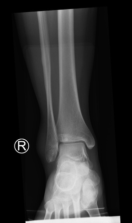 Ankle fracture - Weber A | Image | Radiopaedia.org