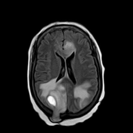 Extracranial brain herniation | Radiology Reference Article ...