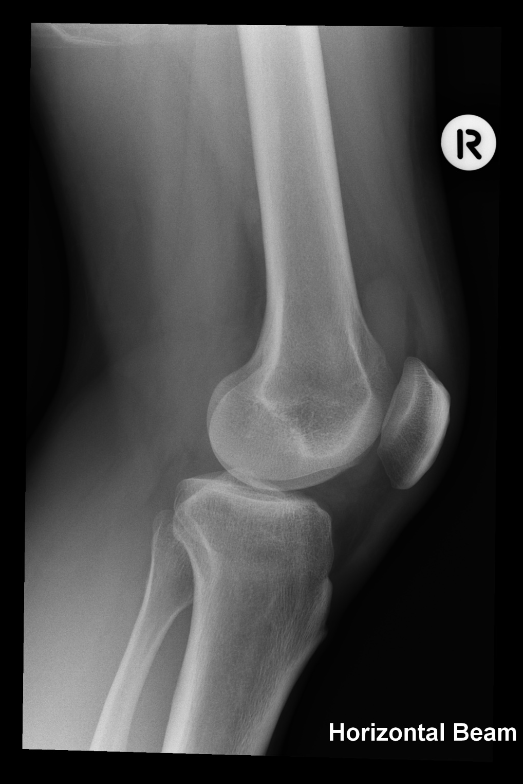 Knee lipohemarthrosis due to tibial plateau fracture | Image ...