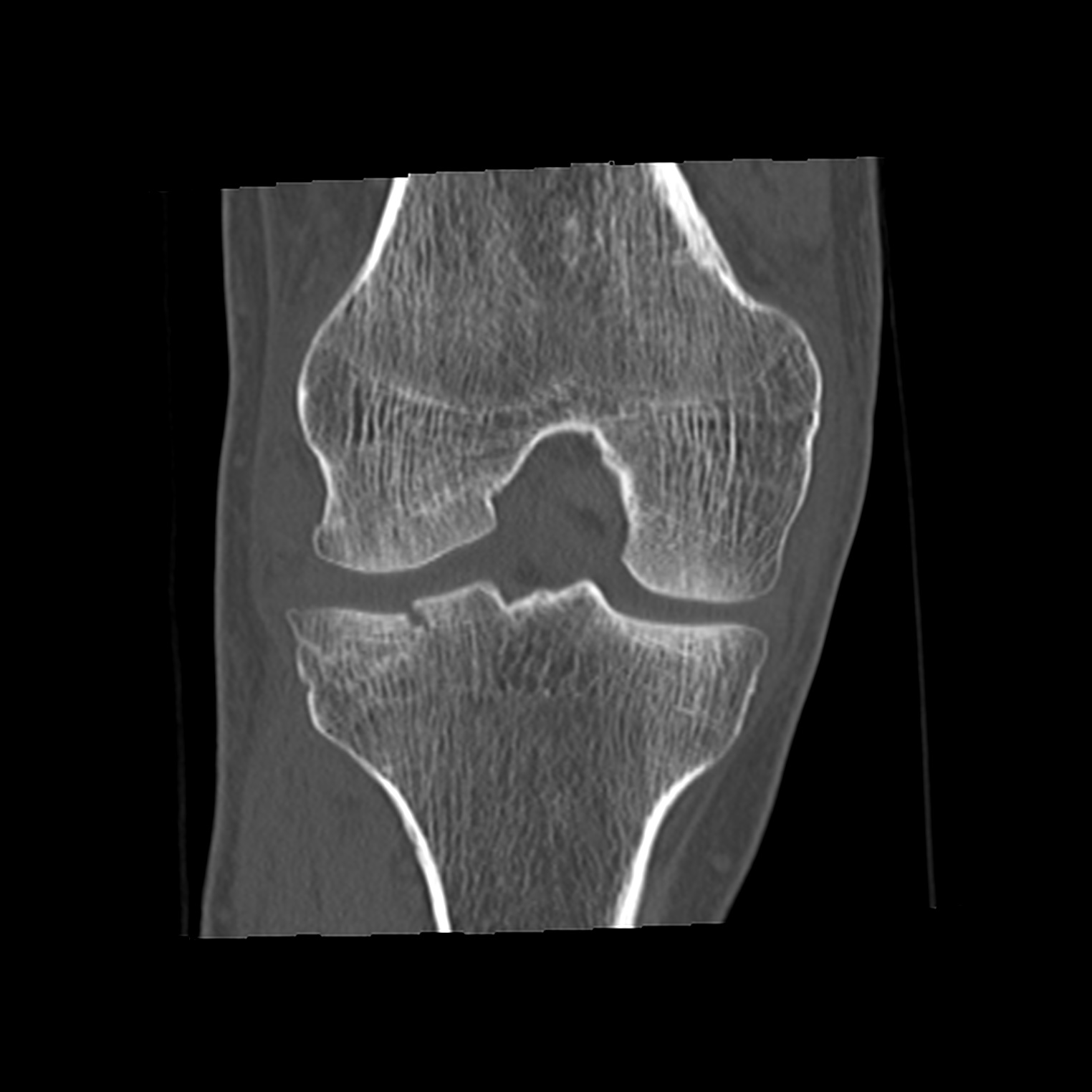 Knee lipohemarthrosis due to tibial plateau fracture | Image ...