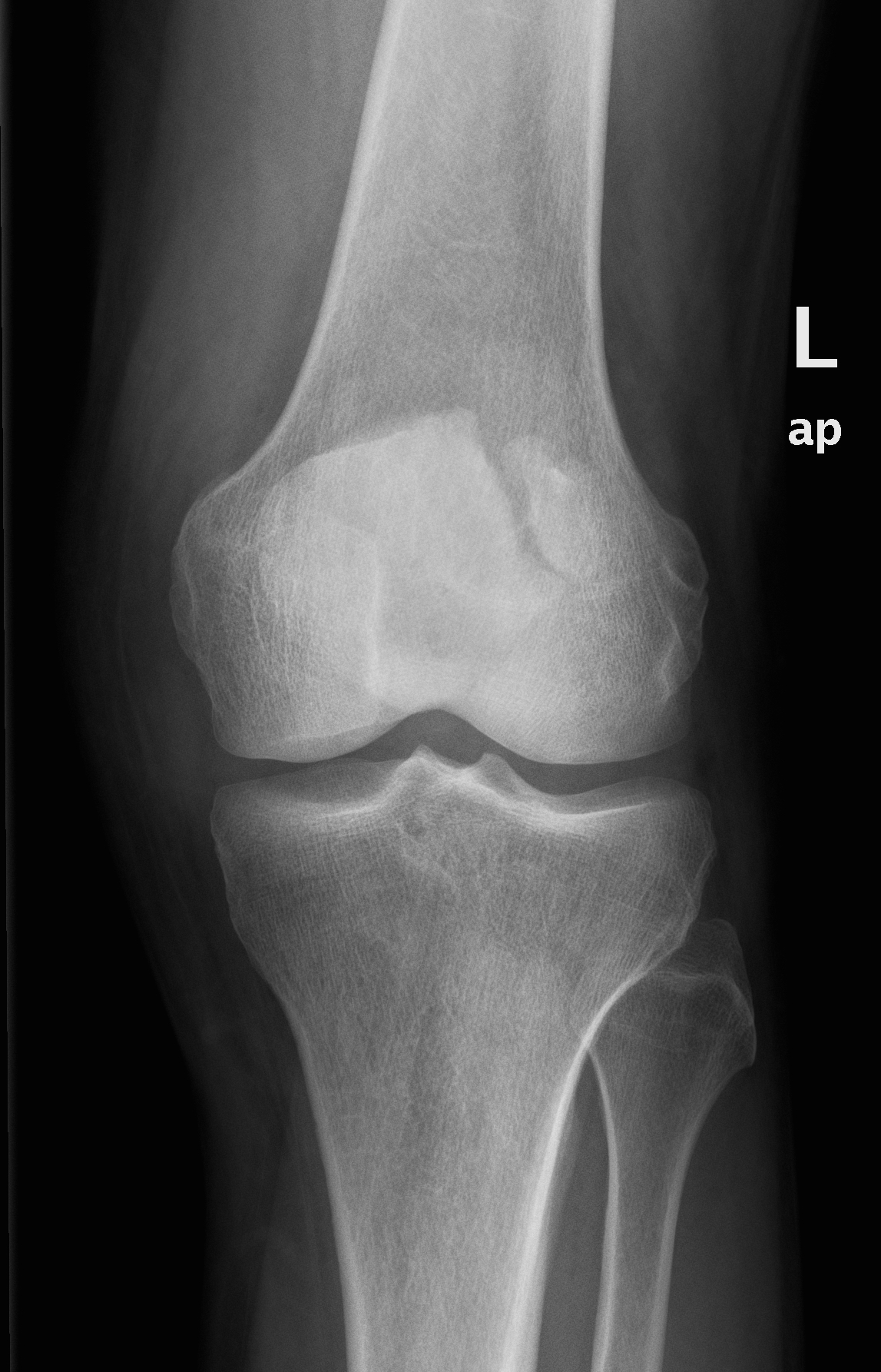 Xray Tech Times Patella Fracture Xray Tech X Ray