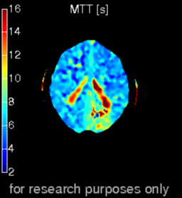 Left posterior cerebral artery territory stroke | Image | Radiopaedia.org